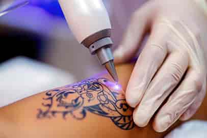 Lézeres tetoválás eltávolítás